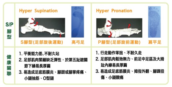 S/P腳型理論比較圖:過度旋後S型腳(高弓足)與過度旋前P型腳(扁平足)