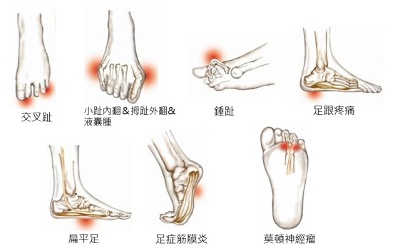 常見足部問題圖解:交叉趾、拇趾外翻、錘趾、足跟痛、扁平足、足底筋膜炎、莫頓神經瘤
