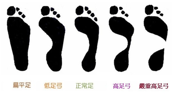 五種常見足型分類特徵圖:扁平足、低足弓、正常足、高足弓、嚴重高足弓