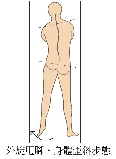 走得更穩、更有自信！林女士的身體重心調整故事