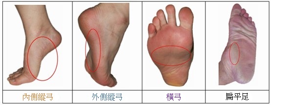 足弓構造對比圖