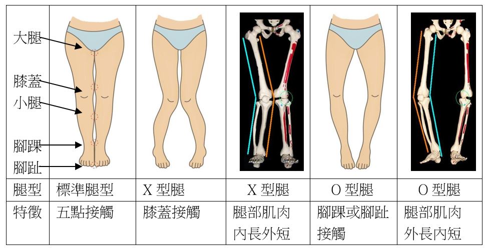 標準腿型與X型、O型腿肌肉張力失衡與骨骼對照表