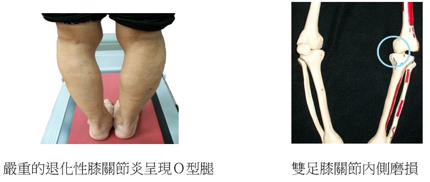 O型腿外觀與膝關節內側磨損骨骼對照圖