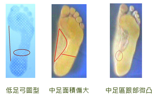 低足弓圖型、中足面積偏大與中足區跟部微凸的腳底特徵對照圖。