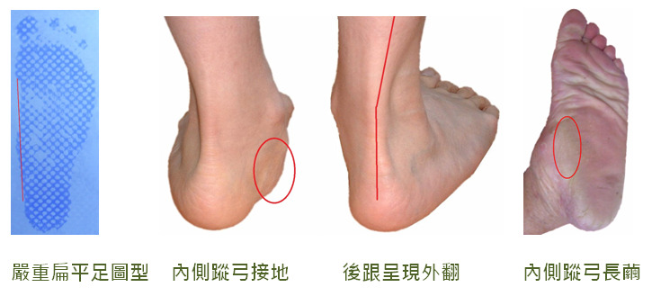 嚴重扁平足特徵對照:包含嚴重扁平足圖型、內側縱弓接地外觀、後跟呈現外翻以及內側縱弓長繭示意圖。