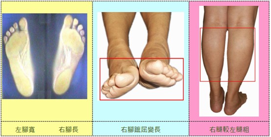 假性大小腳與腳踝轉位造成的腿部肌肉粗細與腳掌外觀差異
