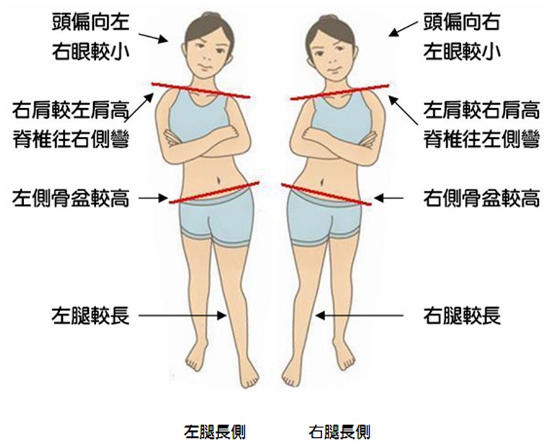 假性長短腿對骨盆傾斜與脊椎側彎的體態影響對比圖
