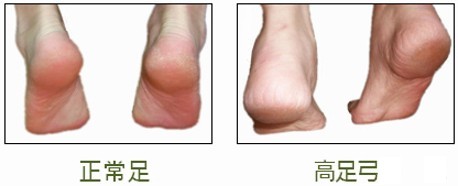 正常足與高足弓顛腳時的弧度對比圖